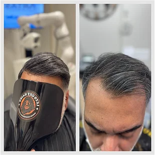 Before and after results showing improved hairline density following treatment - Hair Restoration in New York, NY