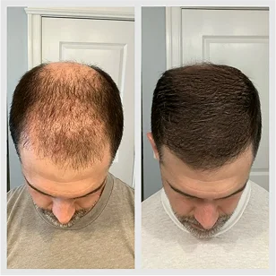 Before and after images showing significant thickening of hair at the crown - Hair Restoration in New York, NY