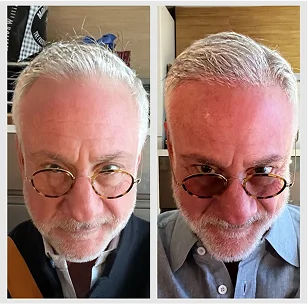 Before and after comparison of a mature man with visibly fuller, denser hair- Hair Restoration in New York, NY