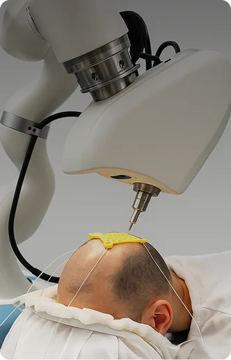 Close-up of a robotic hair transplant device performing follicle extraction on a patient - Hair Restoration iin New York, NY