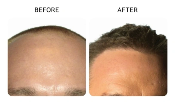 Before and after comparison showing a receding hairline restored with fuller growth- Hair Restoration in New York, NY
