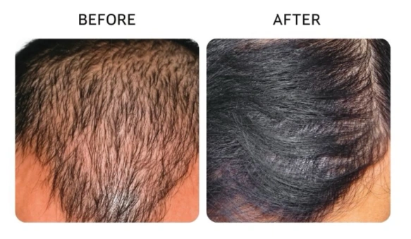 Before and after images showing hairline regeneration and improved front-scalp density- Hair Restoration in New York, NY