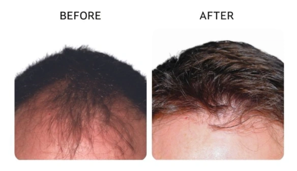 Before and after results showing thicker, healthier hair along a thinning part line- Hair Restoration in New York, NY