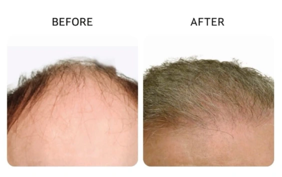 Before and after results showing enhanced density and improved frontal hairline - Hair Restoration in New York, NY