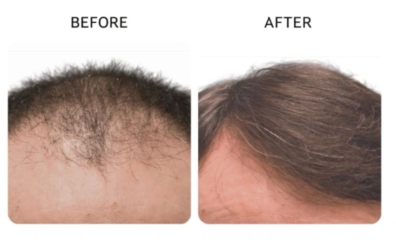 Before and after comparison showing fuller hair coverage on a previously thinning scalp. - Hair Restoration in New York, NY