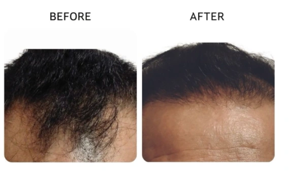 Before and after comparison showing improved density and a fuller frontal hairline. - Hair Restoration in New York, NY