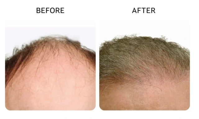 Before and after comparison highlighting a lowered, fuller hairline with thicker growth. - Hair Restoration in New York, NY