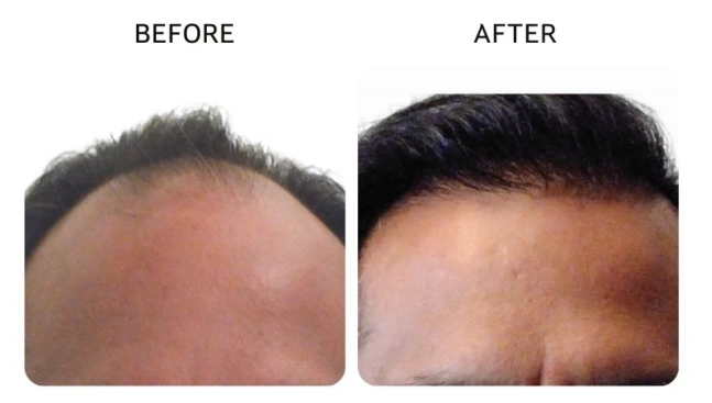 Before and after images showing restored hair thickness and a more defined hairline. - Hair Restoration in New York, NY