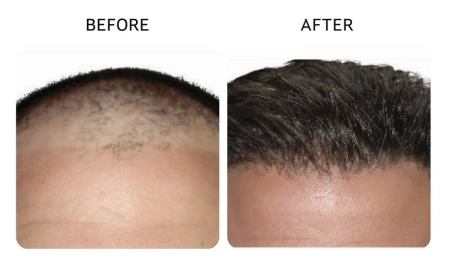 Before and after comparison showing a restored hairline and fuller hair density- Hair Restoration in New York, NY
