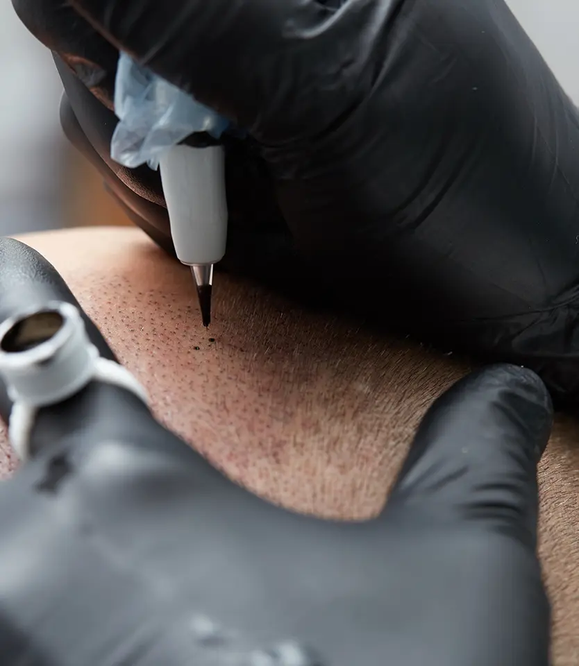 microneedling-intro